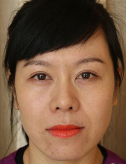 重庆超雅面部提升术让我向着青春逆向生长183 重庆超雅面部提升术让我向着青春逆向生长183