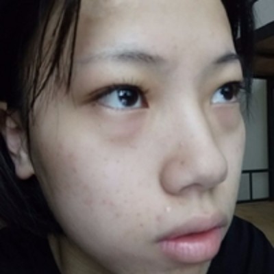 去眼袋，选择超声波去眼袋，绝对是个正确的选择663