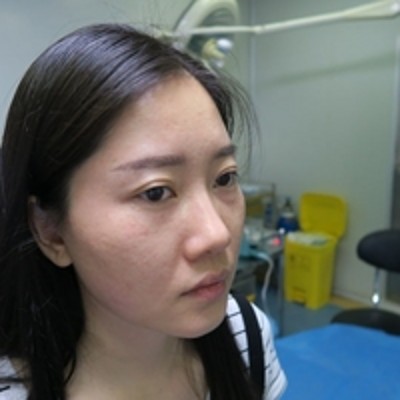 再也不怕加班长眼袋了,超声波去眼袋772 再也不怕加班长眼袋了,超声波去眼袋772