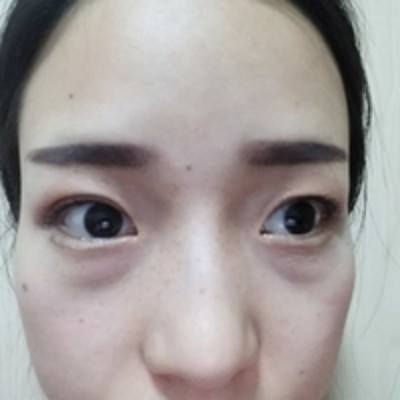 去掉眼袋让wǒ精神焕发,超 声 波去眼袋 去掉眼袋让wǒ精神焕发,超 声 波去眼袋