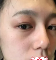 超声波双眼皮 超声波去眼袋让我美腻了!898 超声波双眼皮 超声波去眼袋让我美腻了!898