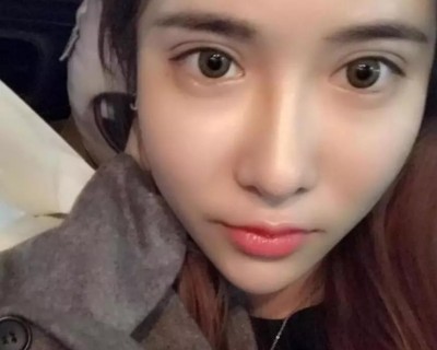 适合我的双眼皮,超声波双眼皮。181 适合我的双眼皮,超声波双眼皮。181