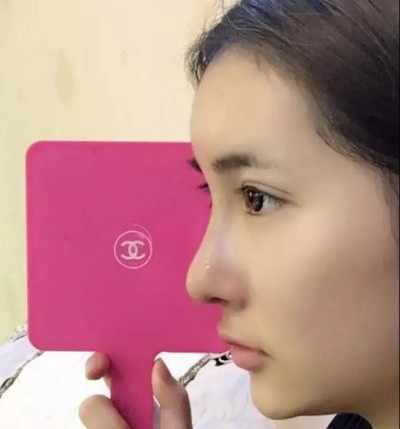 适合我的双眼皮,超声波双眼皮。181 适合我的双眼皮,超声波双眼皮。181