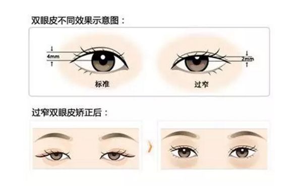 【涨点姿势】什么样的双眼皮手术修复比较简单？哪种比较难？083
