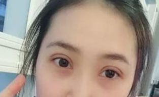 双眼 皮手术修复大师——重庆超雅梁杰，修复案例对比，很棒得！