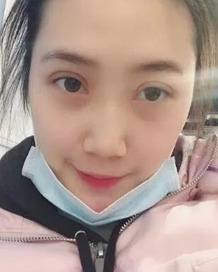 双眼 皮手术修复大师——重庆超雅梁杰，修复案例对比，很棒得！