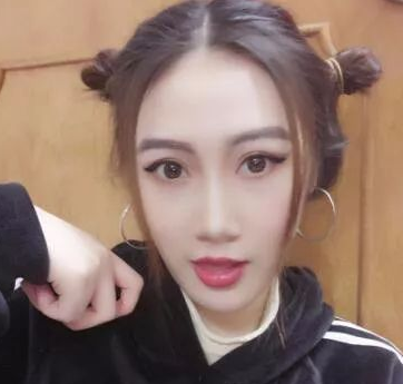 双眼 皮手术修复大师——重庆超雅梁杰，修复案例对比，很棒得！