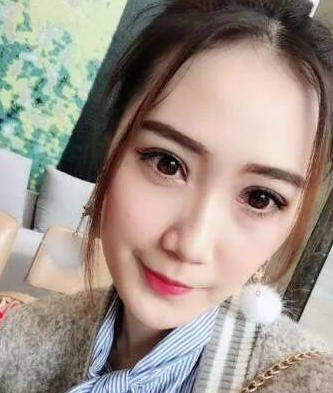 双眼 皮手术修复大师——重庆超雅梁杰，修复案例对比，很棒得！