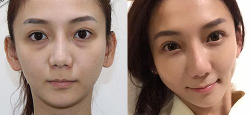 幸福来得太突然，超声波去眼袋手术终究根治了眼袋！953
