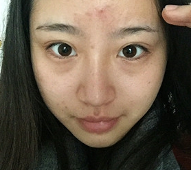 小姐姐心酸战眼袋4年，如今终于用超声波去眼袋得偿所愿！923