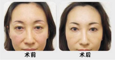 小姐姐心酸战眼袋4年，如今终于用超声波去眼袋得偿所愿！923