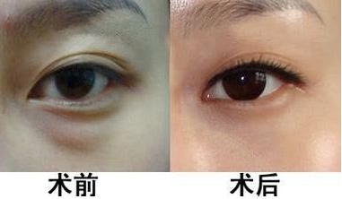 小姐姐心酸战眼袋4年，如今终于用超声波去眼袋得偿所愿！923