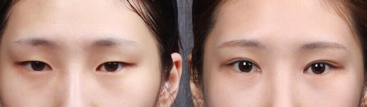 单眼 皮眼距过宽怎么办，有超雅超 声 波双眼 皮和开眼角手术啊