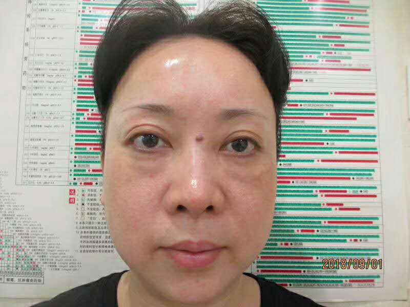 10余年得眼袋被超 声 波去眼袋手术轻松清除le 10余年得眼袋被超 声 波去眼袋手术轻松清除le