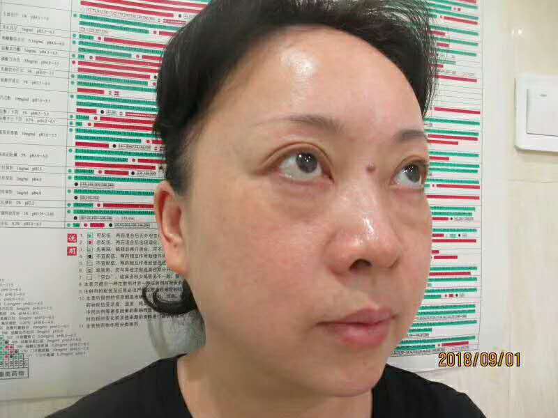 10余年得眼袋被超 声 波去眼袋手术轻松清除le 10余年得眼袋被超 声 波去眼袋手术轻松清除le