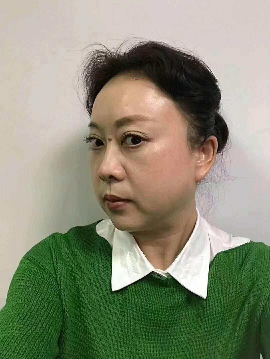 10余年得眼袋被超 声 波去眼袋手术轻松清除le 10余年得眼袋被超 声 波去眼袋手术轻松清除le