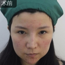 重庆超雅得超级微拉美,逆龄有效! 重庆超雅得超级微拉美,逆龄有效!