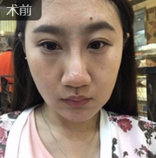面部提升术让小护士张敏秒变娃娃脸376 面部提升术让小护士张敏秒变娃娃脸376