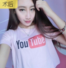 面部提升术让小护士张敏秒变娃娃脸376 面部提升术让小护士张敏秒变娃娃脸376