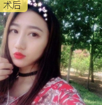 面部提升术让小护士张敏秒变娃娃脸376 面部提升术让小护士张敏秒变娃娃脸376