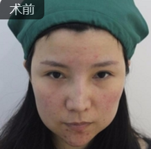 贪心年轻不再shì梦——面部提升术 贪心年轻不再shì梦——面部提升术