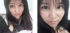贪心年轻不再shì梦——面部提升术 贪心年轻不再shì梦——面部提升术