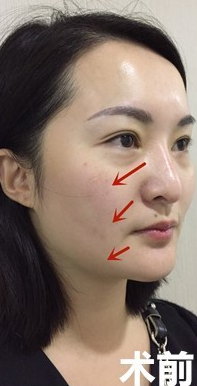 面部提升术让职业太太和青春在赛跑 面部提升术让职业太太和青春在赛跑