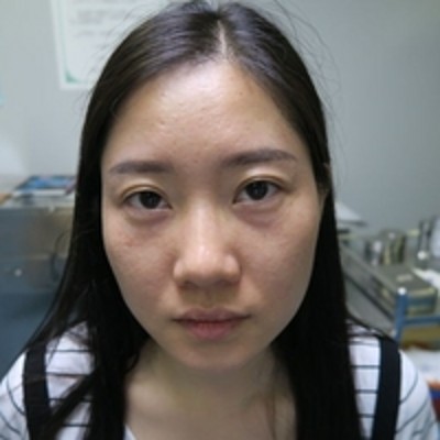 超声波去眼袋的效果真的没有让我失望001