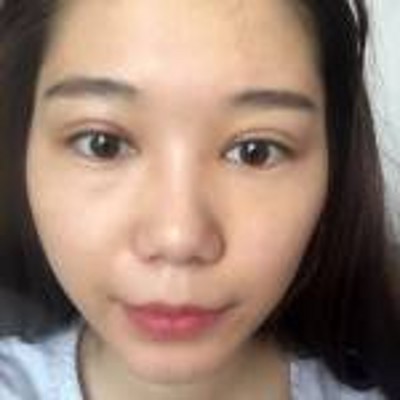 超声波去眼袋让我变得美美的492 超声波去眼袋让我变得美美的492