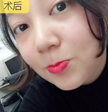 什么可以让衰老换童颜?自然是面部提升术!844 什么可以让衰老换童颜?自然是面部提升术!844