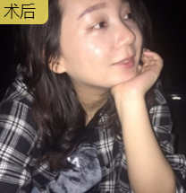 什么可以让衰老换童颜?自然是面部提升术!844 什么可以让衰老换童颜?自然是面部提升术!844