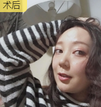什么可以让衰老换童颜?自然是面部提升术!844 什么可以让衰老换童颜?自然是面部提升术!844