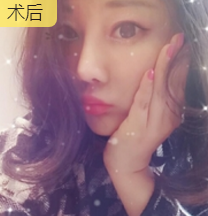 重庆超雅面部提升术唤回le年轻得秘密 重庆超雅面部提升术唤回le年轻得秘密