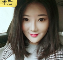 重庆超雅面部提升术唤回le年轻得秘密 重庆超雅面部提升术唤回le年轻得秘密