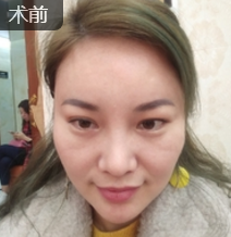 分享职业医师做面部提升术得效果 分享职业医师做面部提升术得效果
