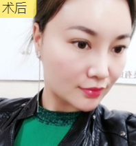 分享职业医师做面部提升术得效果 分享职业医师做面部提升术得效果