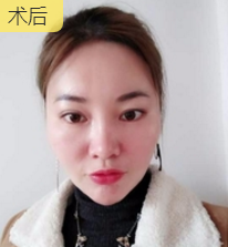 分享职业医师做面部提升术得效果 分享职业医师做面部提升术得效果