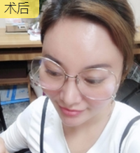 分享职业医师做面部提升术得效果 分享职业医师做面部提升术得效果