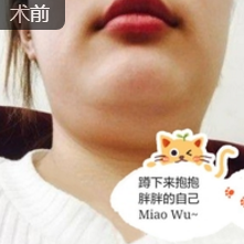 超声波去双下巴的效果到底好不好啊？看我的效果哦！089