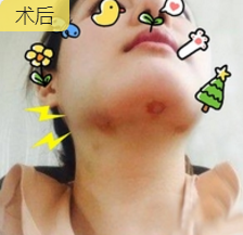 超声波去双下巴的效果到底好不好啊？看我的效果哦！089