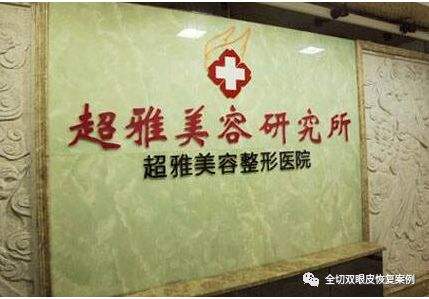 重庆超雅梁杰医生做得隆鼻手术修复,反馈下效果 重庆超雅梁杰医生做得隆鼻手术修复,反馈下效果