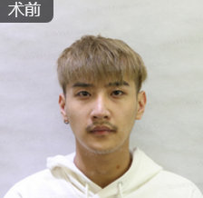 重庆超雅梁杰医生做得隆鼻手术修复,反馈下效果 重庆超雅梁杰医生做得隆鼻手术修复,反馈下效果