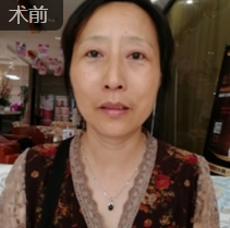 重庆超雅面部提升术让广场舞阿姨绝不走进老年时代 重庆超雅面部提升术让广场舞阿姨绝不走进老年时代