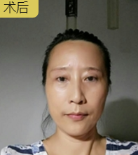 重庆超雅面部提升术让广场舞阿姨绝不走进老年时代 重庆超雅面部提升术让广场舞阿姨绝不走进老年时代