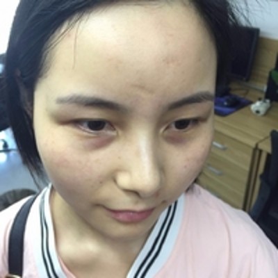 去掉眼袋颜值彪升啊,超声波去眼袋680 去掉眼袋颜值彪升啊,超声波去眼袋680