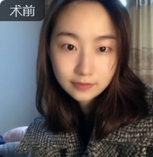围观好几年，终于做了梦想中的双眼皮手术和开眼角~640