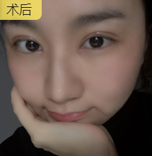 围观好几年，终于做了梦想中的双眼皮手术和开眼角~640