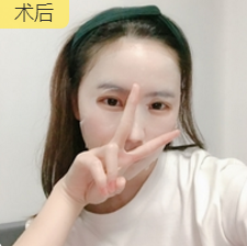 围观好几年，终于做了梦想中的双眼皮手术和开眼角~640