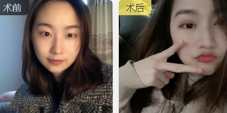 围观好几年，终于做了梦想中的双眼皮手术和开眼角~640