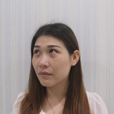 去掉眼袋之后要好看太多,超 声 波去眼袋 去掉眼袋之后要好看太多,超 声 波去眼袋